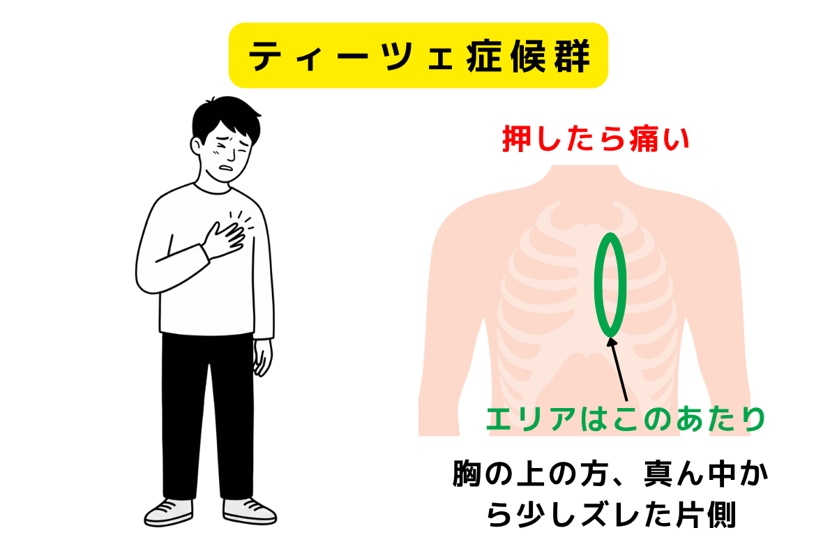 胸 の 痛み 真ん中